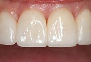Dental Illuminations | Lumineers reg , Dental Fillings and Intraoral Cameras