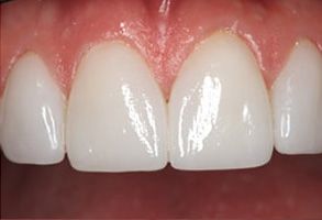 Dental Illuminations | Periodontal Treatment, Dentures and Extractions