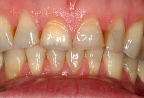 Dental Illuminations | Ceramic Crowns, Invisalign reg  and Periodontal Treatment
