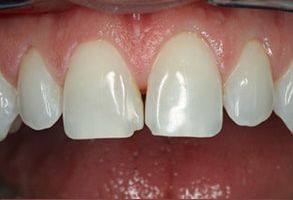 Dental Illuminations | Preventative Program, Oral Exams and Invisalign reg 